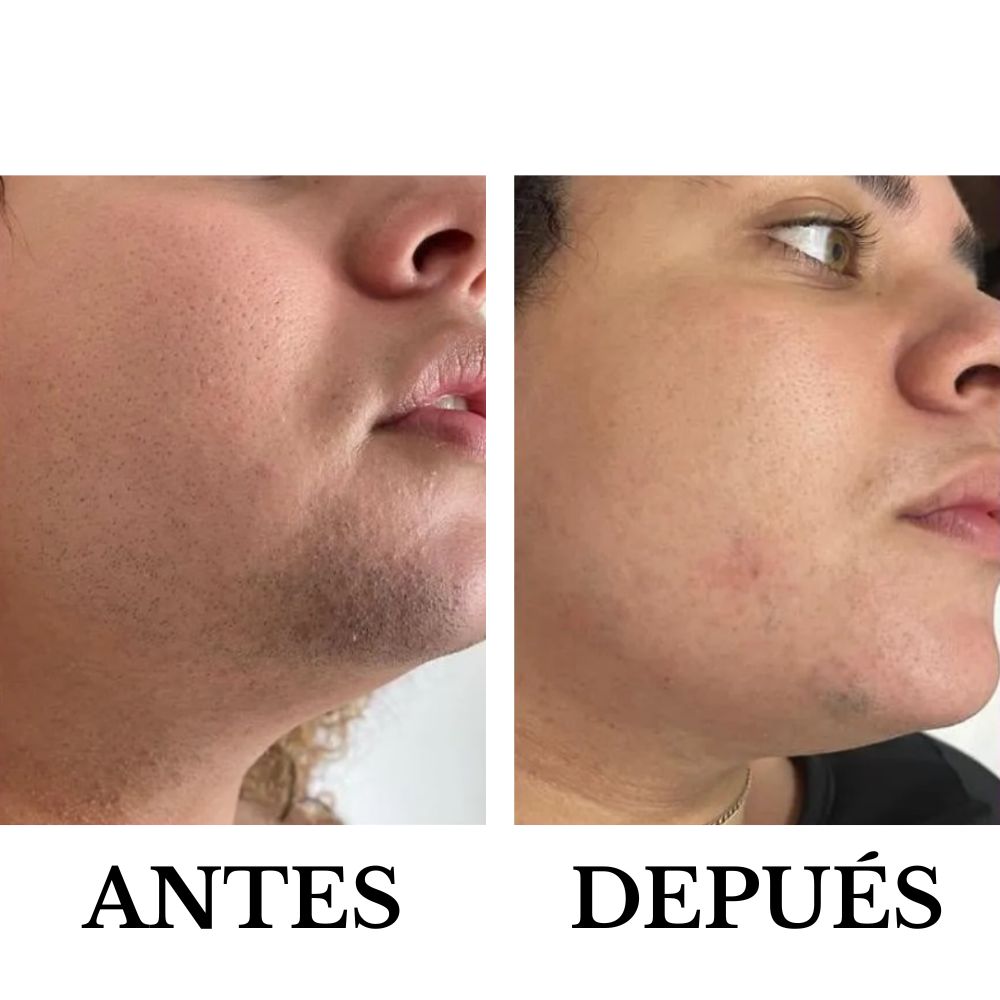 Depiladora láser IPL