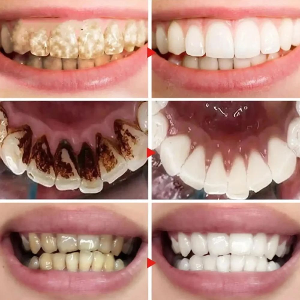 Clareador Dental V34 Lilás – COMPRA 1 Y LLÉVATE 2