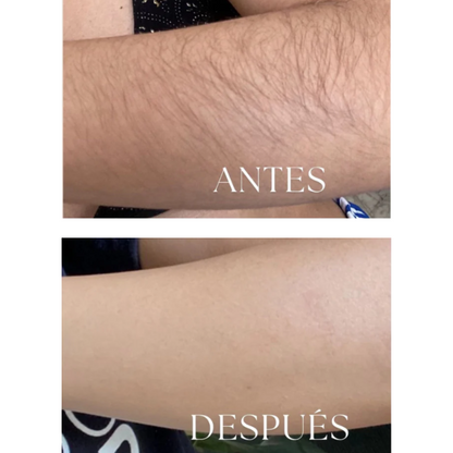 Depiladora láser IPL